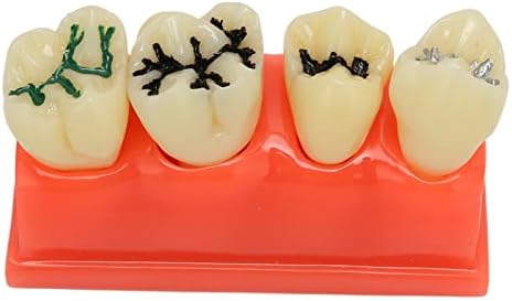 Модел на стоматолошки кариес, интуитивно учење на модел на заби, јасна структура 4 заби за демонстрација за стоматолошки болници