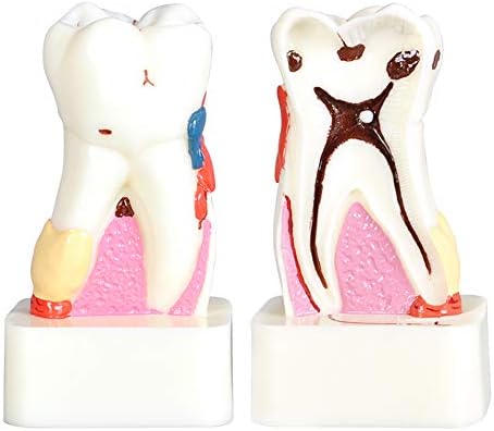 KH66ZKY 4 пати модел на стоматолошки кариес Сеопфатен патологија модел на заби кариес калкулус пулпа залак абење патолошки модел на демонстрација