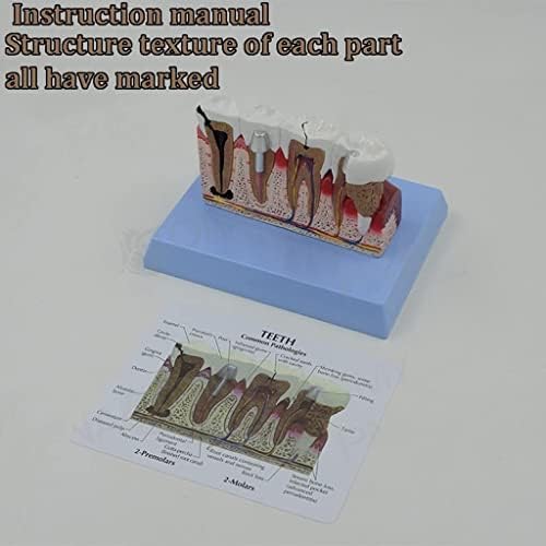 Luvadu ZCX анатомија модел на настава модел за заби патологија заби модел Модел на распаѓање на заби Компаративна студија модел на анатомија