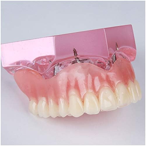 KH66ZKY Импланти за претерано деловно учење - Модел на заби на заби - Модел на заби за демонстрација за образование на пациенти