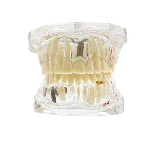 Транспарентен модел на заби на заболувања со мост за забни импланти, стоматолошки модел за студентски и стоматолошко образование